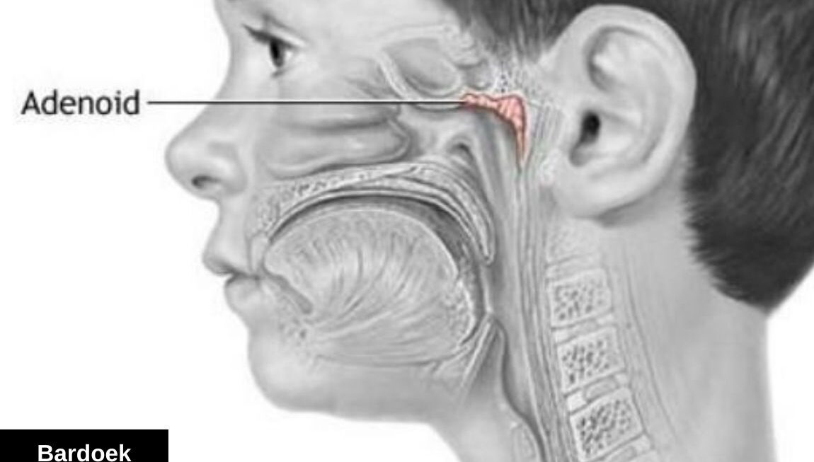 Adenoidid: A Complete Guide for Parents (Ultimate 2026 Edition)