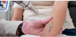Benefits of Seeing an Expert Tattoo Removal Specialist
